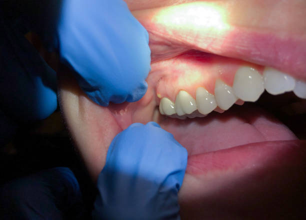 Best Broken or Chipped Tooth Repair in Slocom, AL